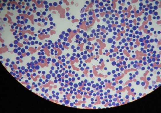 Células de leucemia