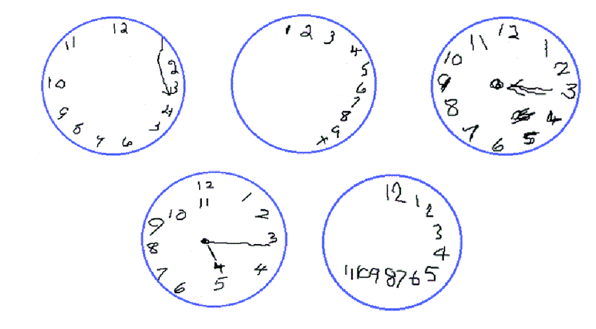 Test de reloj para detectar la enfermedad de Alzheimer