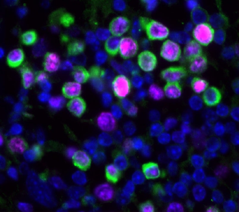 La infección por el virus de la influenza (gripe) provoca el despertar y la expansión de células cancerosas latentes en los pulmones de ratones. Las células cancerosas se muestran en verde y el marcador de proliferación en magenta.