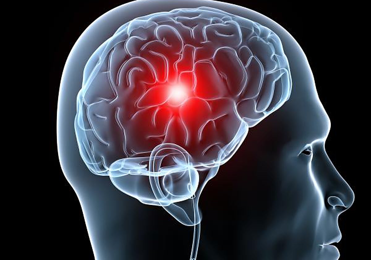 Estos son los 5 síntomas de alerta del ictus y así puedes prevenirlo