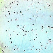 La IA logra un embarazo imposible tras detectar los dos únicos espermatozoides viables de un hombre