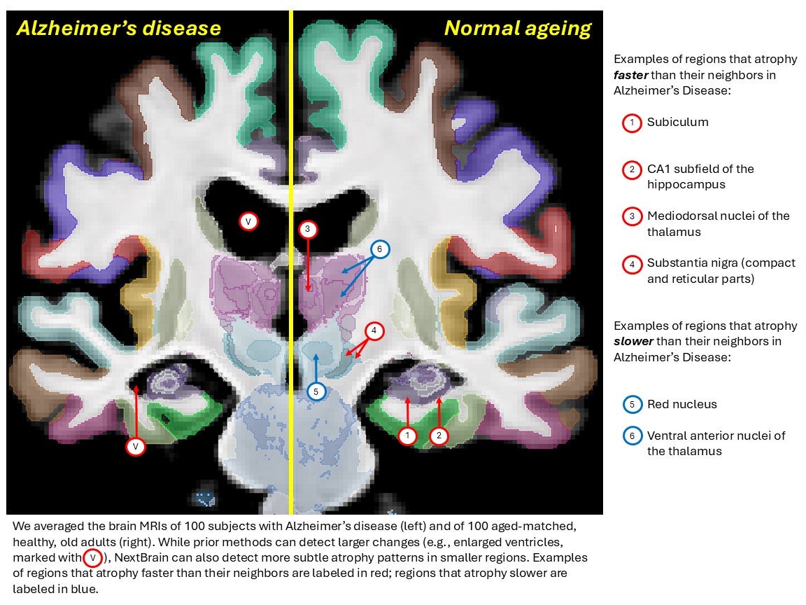 Mapa de cerebro con enfermedad de Azlzheimer y sin ella