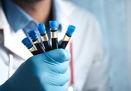 Un análisis de sangre identifica el riesgo temprano de padecer alzhéimer