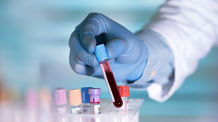 Una nueva terapia con anticuerpos erradica el mieloma múltiple en 18 pacientes