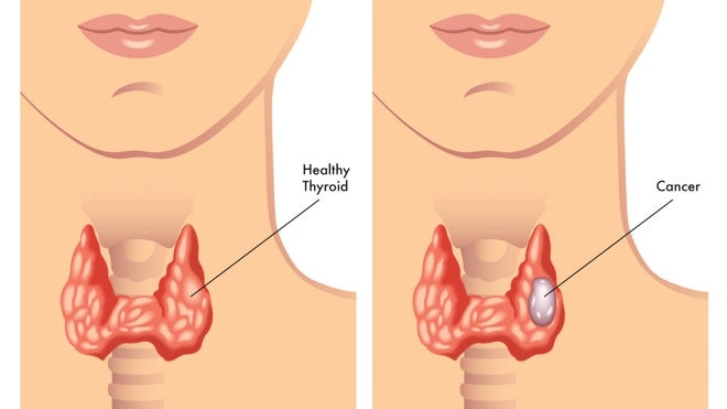 Tiroides sano y tiroides canceroso