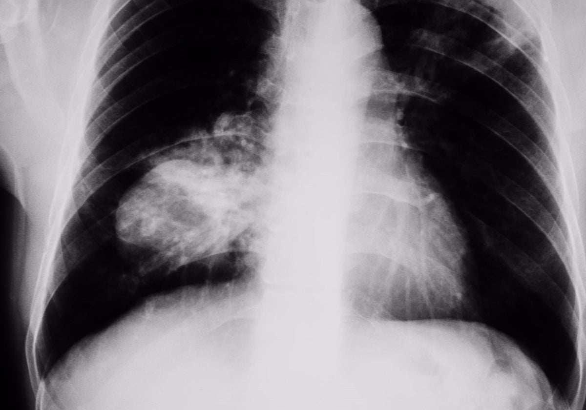 En el trabajo han participado investigadores de la US y de los hospitales Macarena y Virgen del Rocío de Sevilla