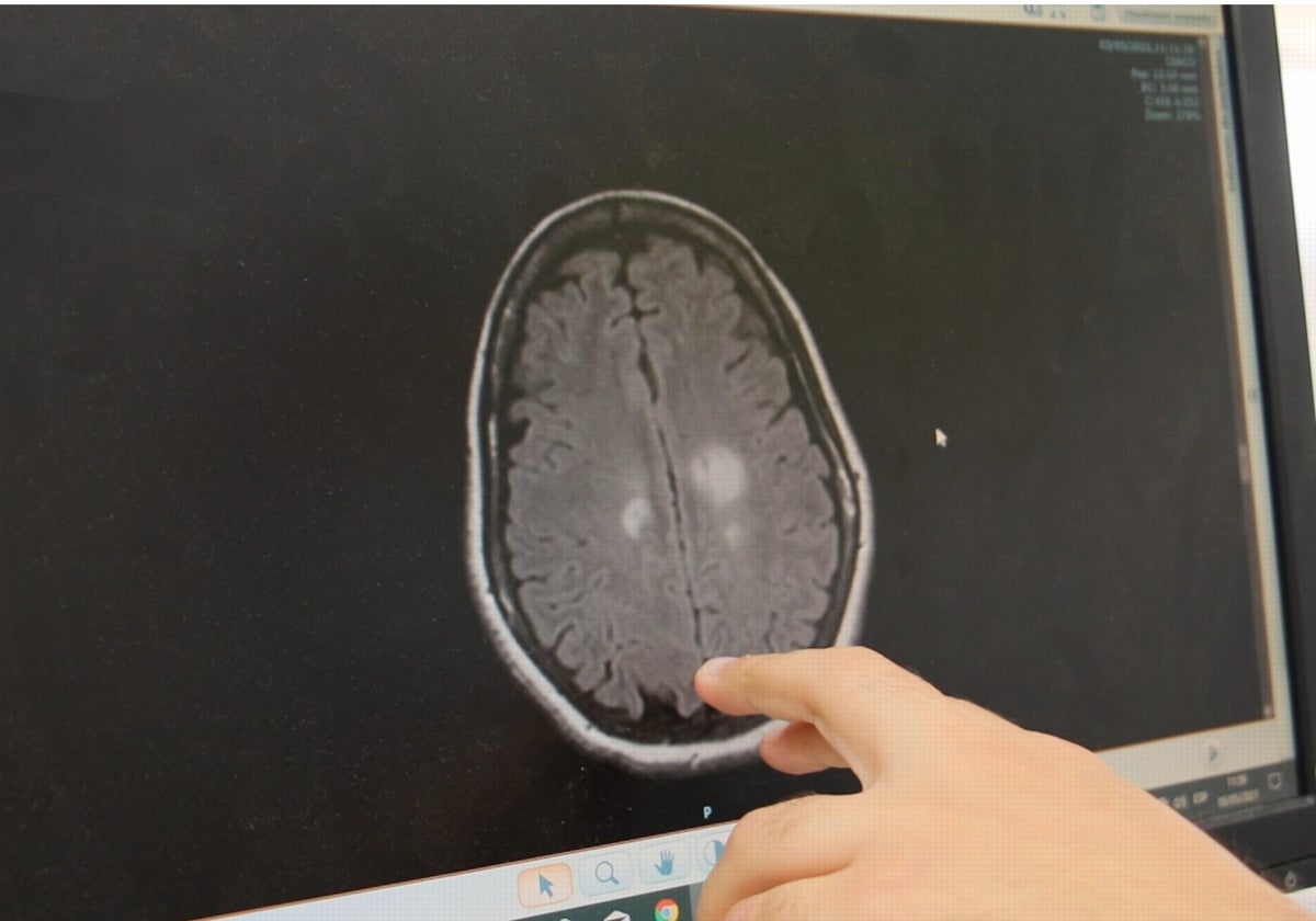 Un neurólogo analiza una imagen cerebral en la Unidad de Ictus del Virgen Macarena de Sevilla