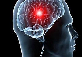 Más de 3.000 personas sufren un ictus en Sevilla cada año