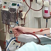 Un paciente se somete a hemodiálisis