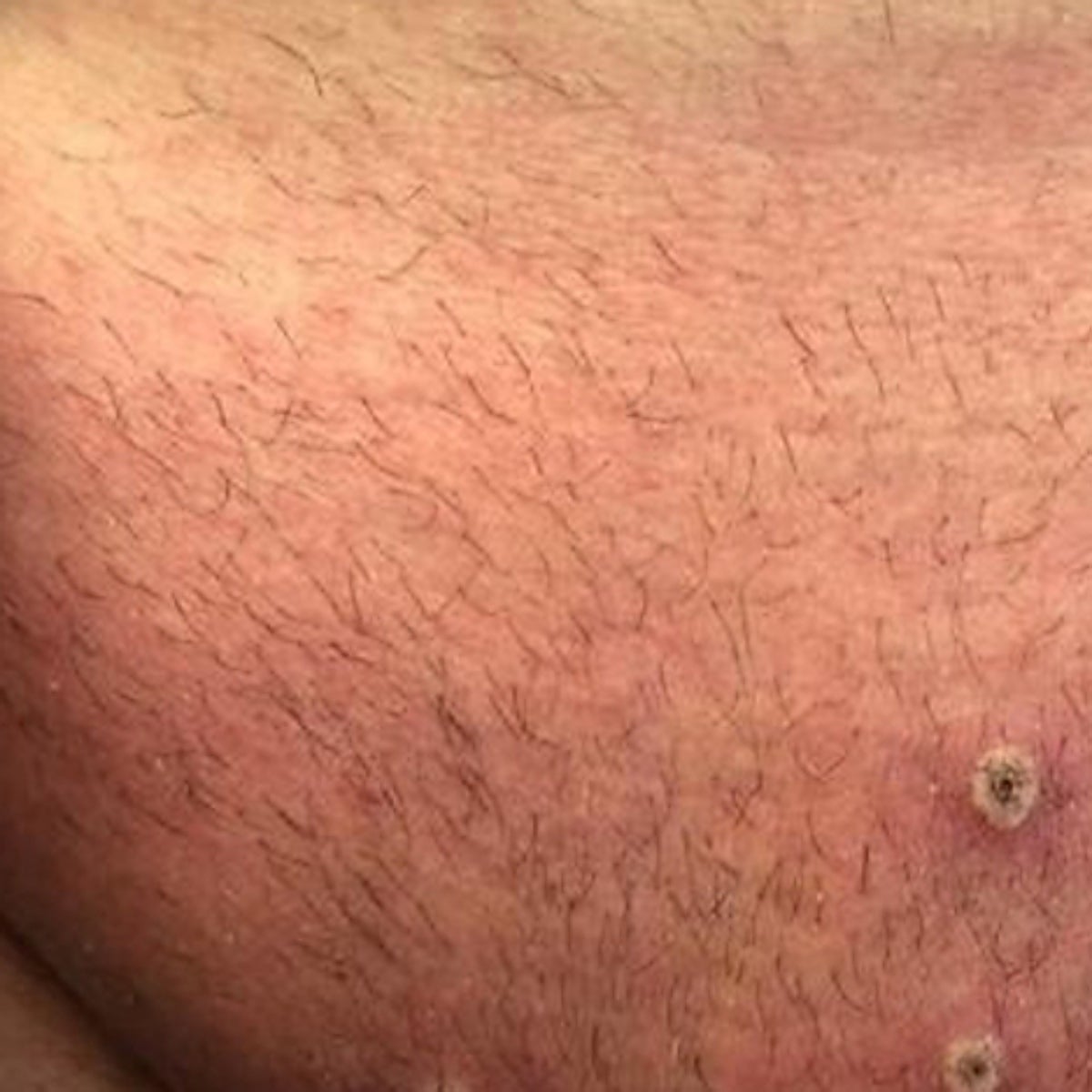 Primera víctima mortal por viruela del mono en España