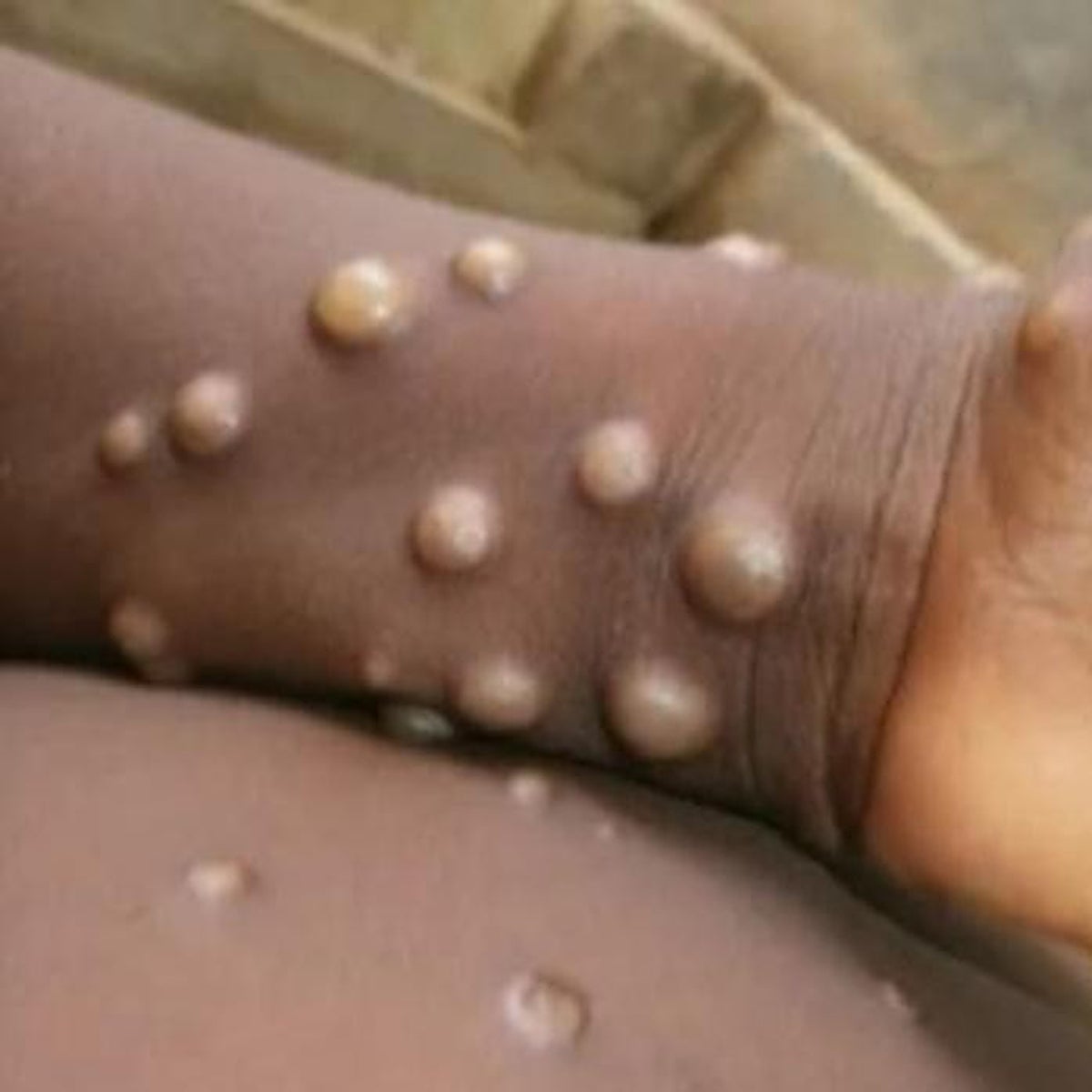 San Francisco declara el estado de emergencia por la viruela del mono