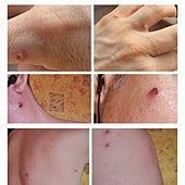 Imagen - Las lesiones pueden aparecer tras compartir inodoro, ropa, objetos o sábanas con un infectado, como le pasó a Alfred K.