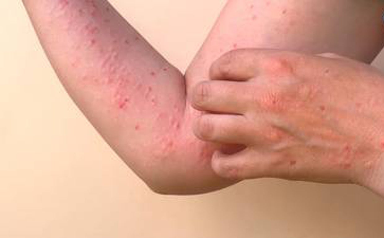 Un total de 82 niños han sufrido fiebre del tomate en India