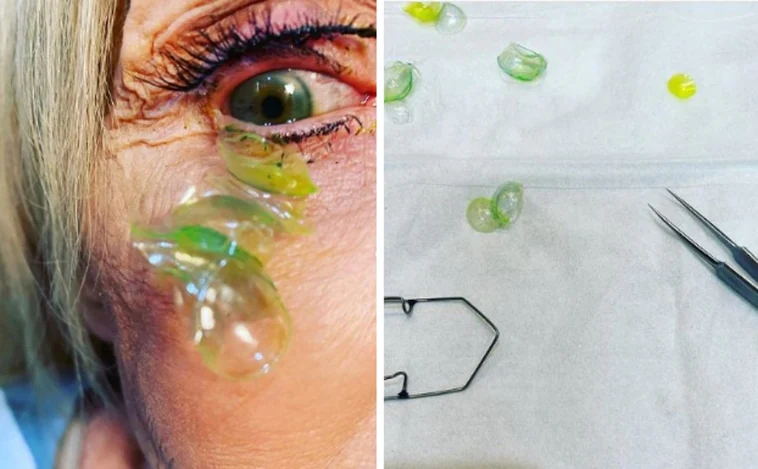 La advertencia de una oftalmóloga tras sacar 23 lentillas de un ojo
