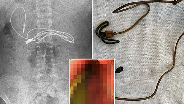 El terrible dolor de tripa de un adolescente que resultó estar causado el cargador de un metro que tenía en el estómago
