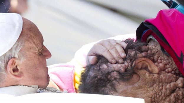 Francisco bendice a Vinicio Riva, con el rostro desfigurado por la neurofibromatosis que padece