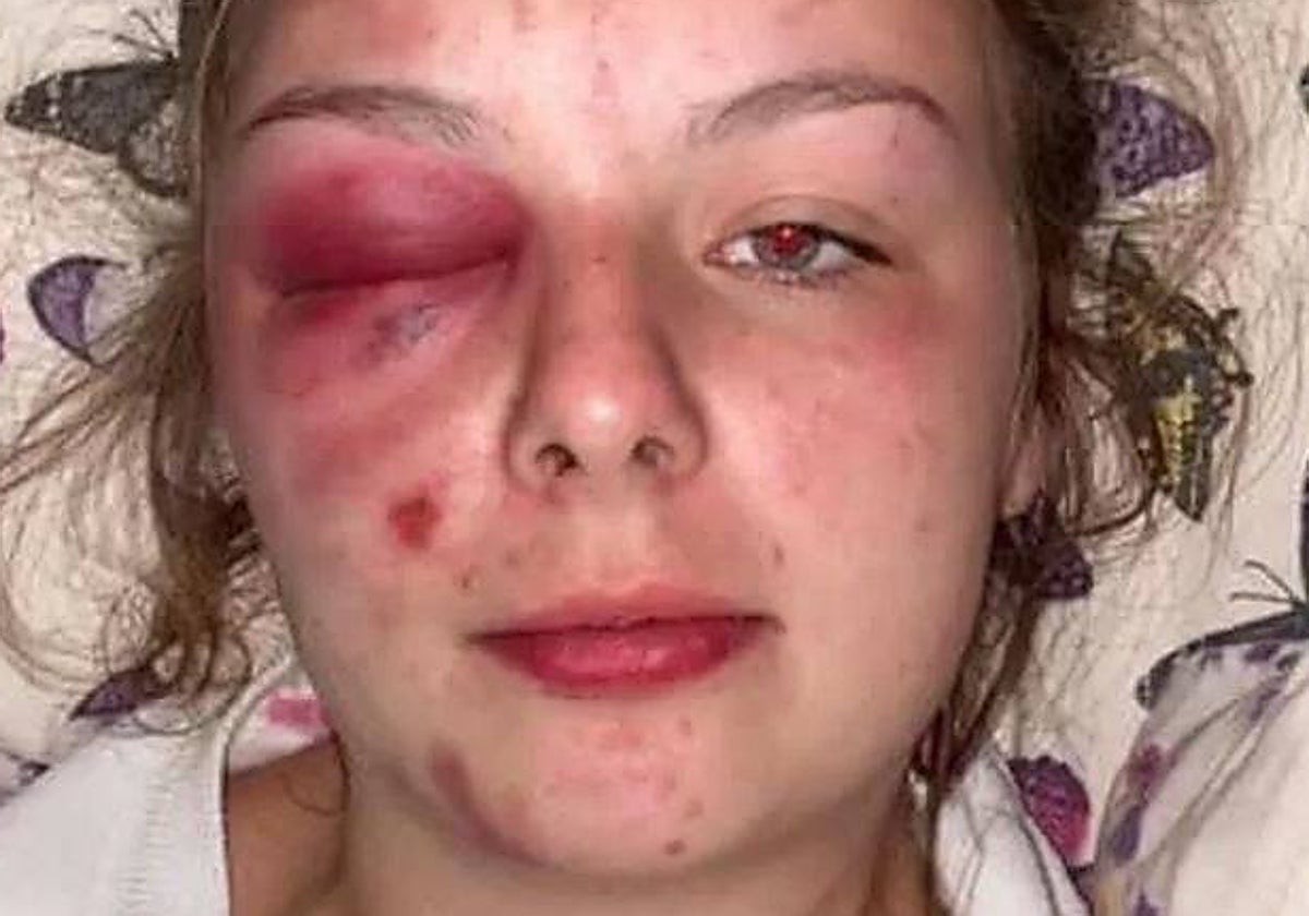 Imagen que Eleanor compartió con las supuestas lesiones sufridas