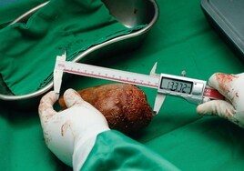 Médicos extraen la piedra de riñón más grande y pesada del mundo