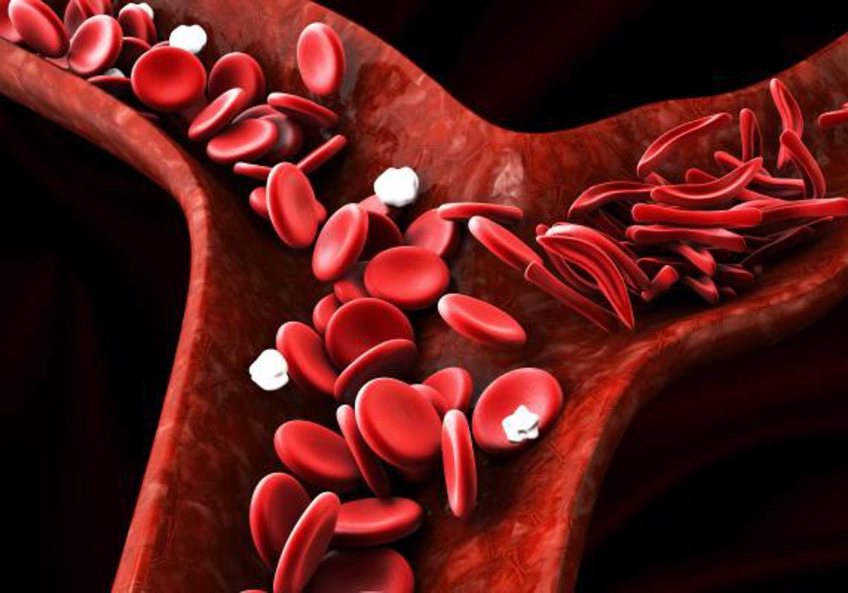 Recreación con células sanguíneas deformadas, típicas de la anemia falciforme