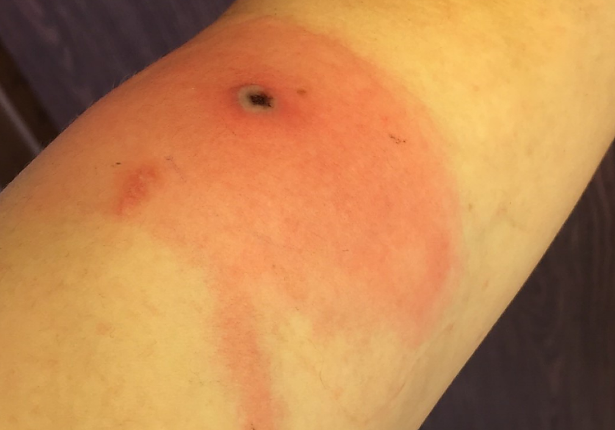 Lesiones cutáneas originadas por el virus 'Alaskapox'