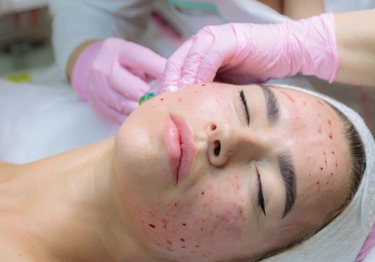 Tres mujeres se infectan de VIH después de realizarse un 'tratamiento facial vampiro'