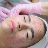 Tres mujeres se infectan de VIH después de realizarse un 'tratamiento facial vampiro'