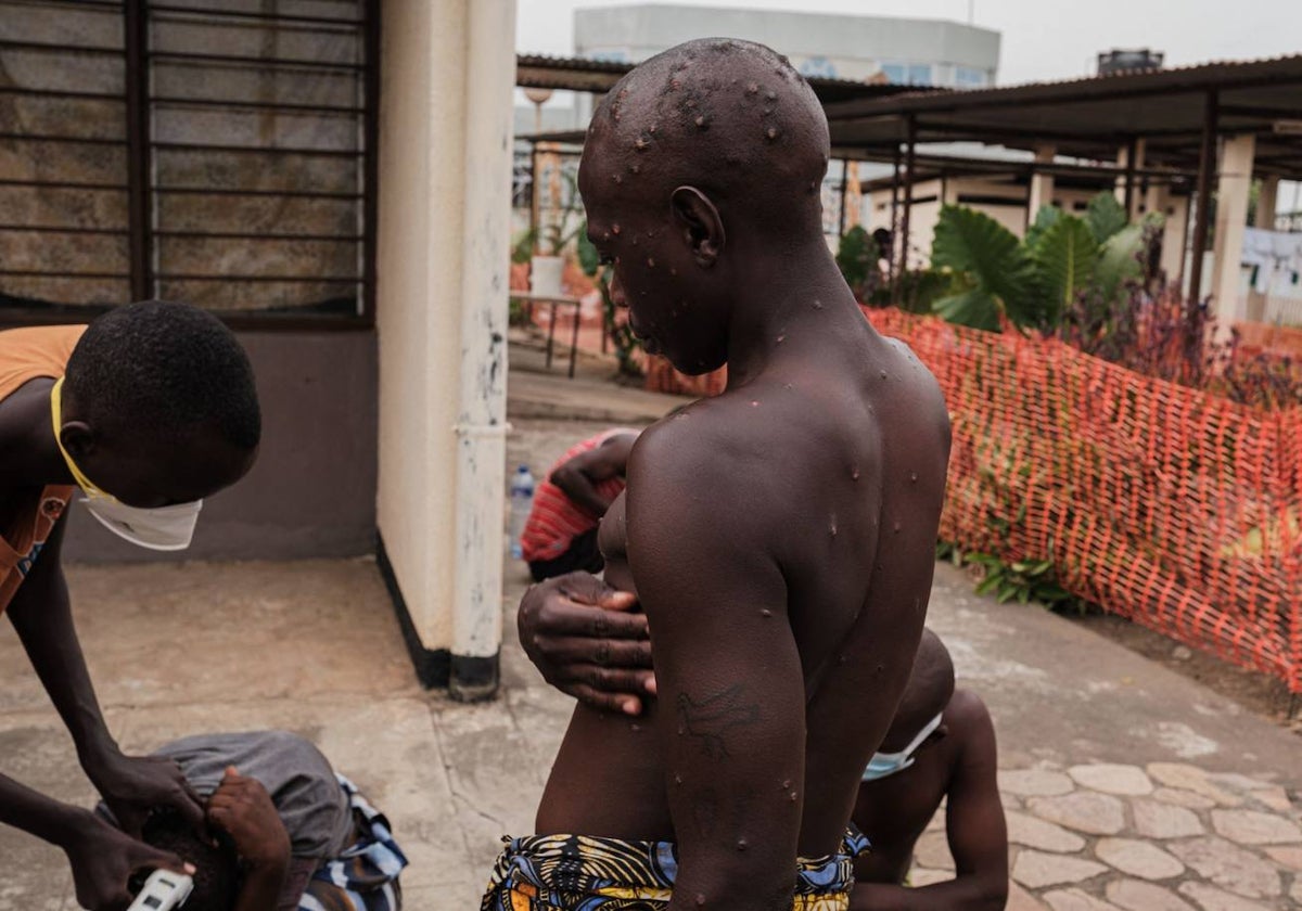 Un hombre afectado por mpox