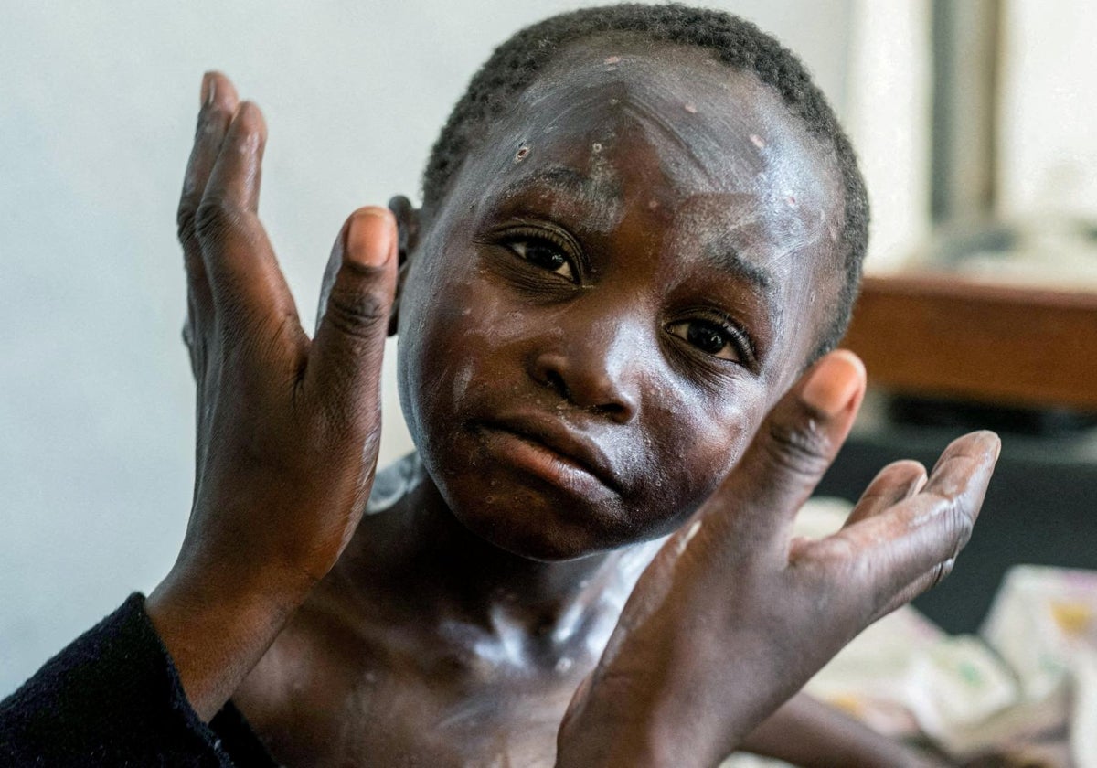 Un niño con viruela del mono, la última epidemia que ha golpeado a la República Democrática del Congo