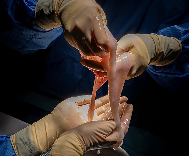 La placenta, antes de su preparación