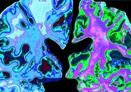 Un cerebro normal de una persona de 70 años (izquierda), comparado con el cerebro de una persona de 70 años con enfermedad de Alzheimer.