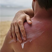 Cinco errores habituales al usar la crema solar que podrían provocar quemaduras en la piel