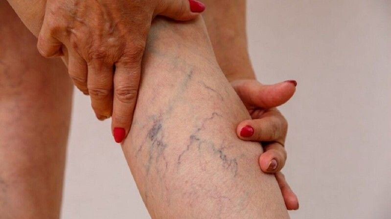 Cómo aparecen las varices y cómo tratarlas
