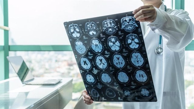 Un fármaco contra el alzheimer que ralentiza el deterioro cognitivo