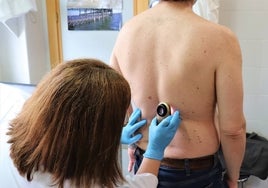 Campaña del Euromelanoma contra el cáncer de piel: así puedes solicitar una consulta en el Hospital Juan Ramón Jiménez