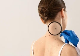 La regla ABCDE para detectar precozmente el melanoma, el cáncer de piel más peligroso