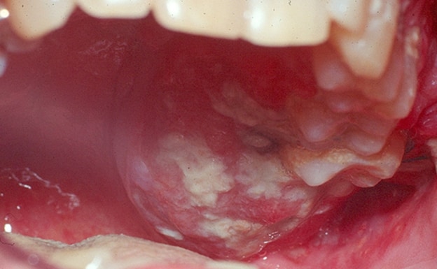 Síntomas que avisan de que puedes tener un cáncer de lengua
