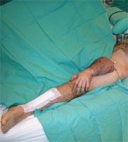 Reimplantan un brazo a un hombre que lo perdió en un accidente tras conectarlo a la circulación de una pierna