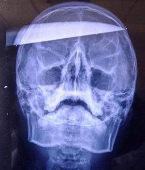 Apuñalado en la cabeza por hacer trampas en un videojuego