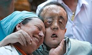 El paciente trasplantado de cara en el Virgen del Rocío de Sevilla recibe el alta