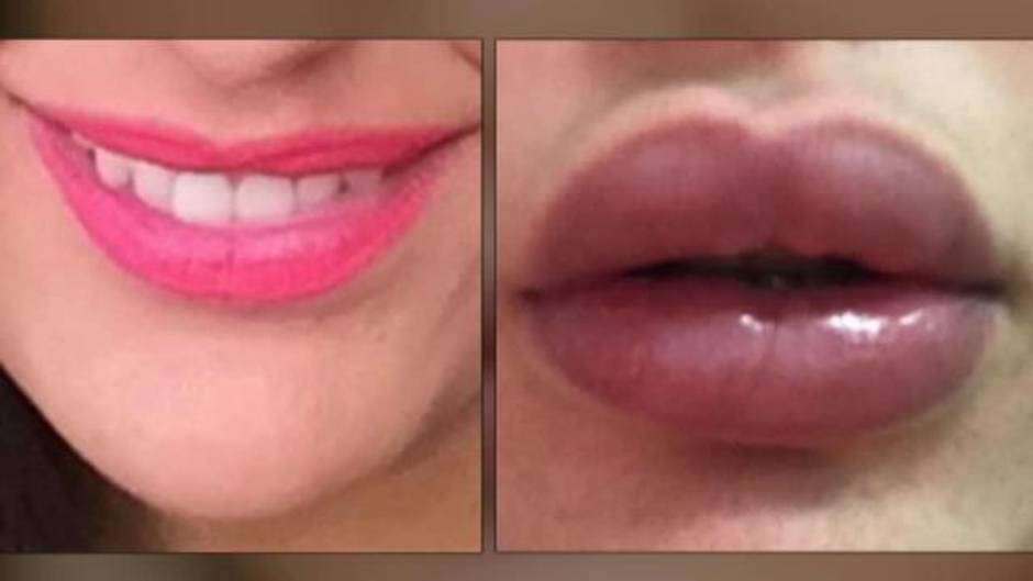 Detenida una mujer en Las Palmas por hacerse pasar por médico jubilada e inyectar silicona en los labios de ocho mujeres