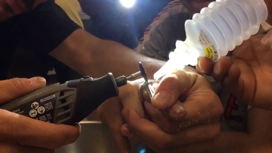 Bomberos cortan un anillo del dedo de un niño
