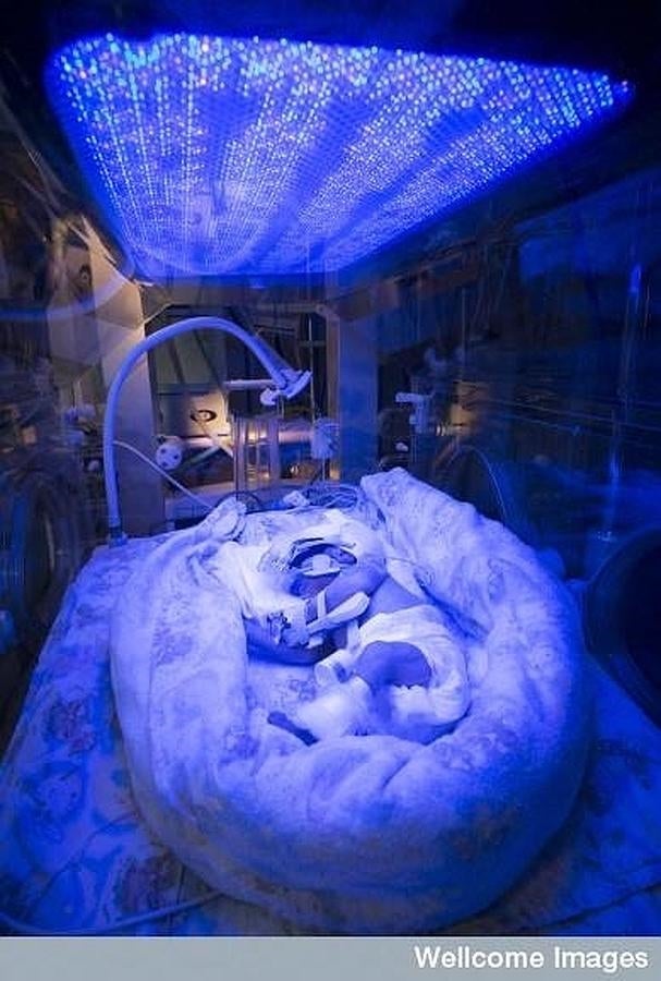 Bebé prematuro recibiendo terapia con luz. 