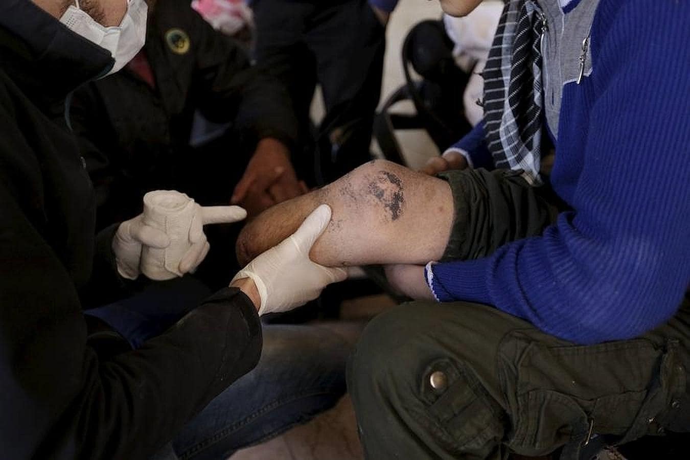 Khamis examina la pierna mutilada de iun hombre en el asentamiento rebelde de Maaret al-Numan