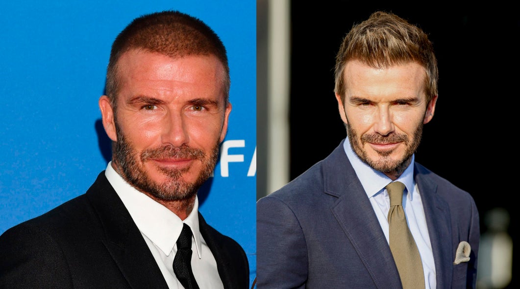 David Beckham. La sospecha de un posible trasplante capilar también planea sobre David Beckham. Aunque no ha hablado sobre ello, el ex futbolista luce en la actualidad un pelo muy abundante que podría ser fruto de un injerto. Cabe señalar que este tratamiento no solo soluciona problemas de calvicie, sino que también es una buena opción ante la pérdida de densidad, para frenar la caída.