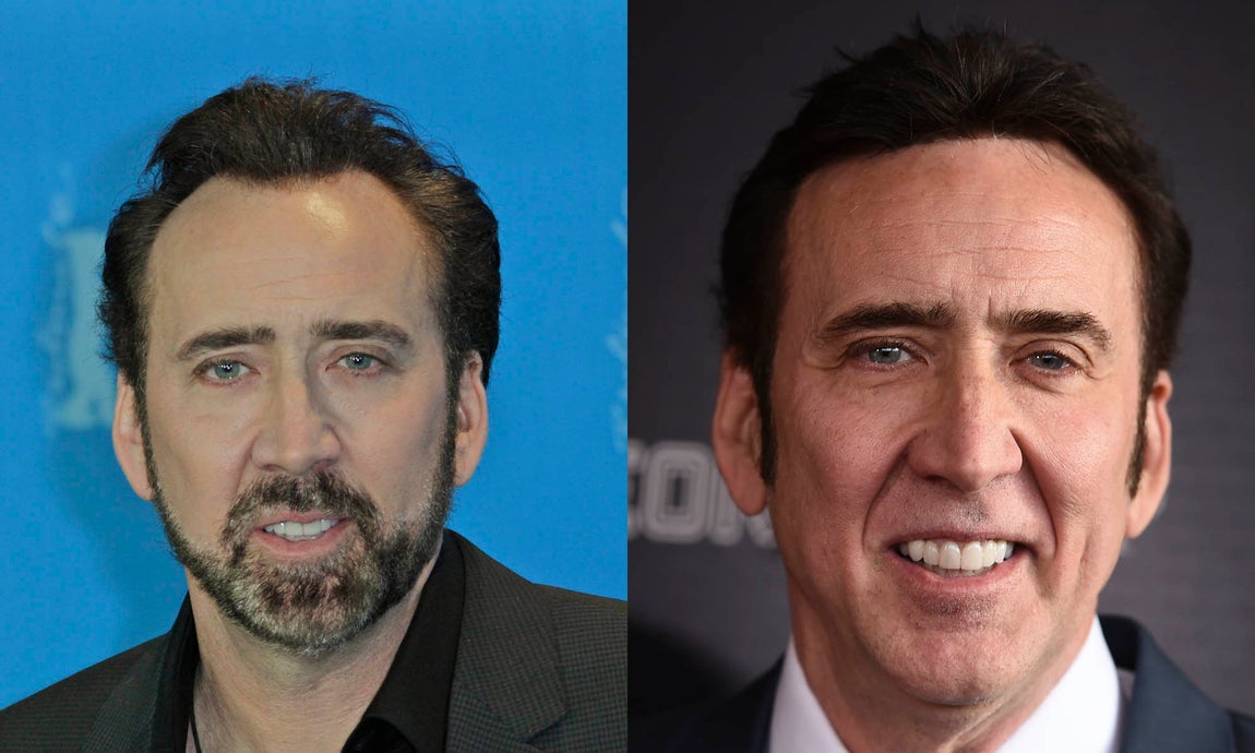Nicolas Cage. Otro de los famosos que se ha sometido a un injerto capilar es el actor Nicolas Cage, como se ve en las imágenes. En la izquierda, año 2013, en la derecha, imagen actual. Las entradas han desaparecido gracias al trasplante capilar.