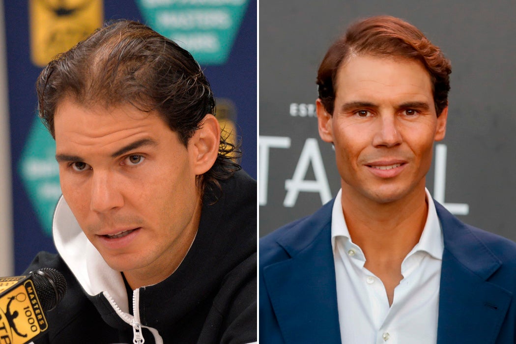 Rafa Nadal. Los deportistas también recurren al injerto capilar para renovar su cabello. Uno de los casos más comentados es el de Rafa Nadal. En 2015 el pelo del tenista clareaba bastante, y actualmente, en cambio, luce un pelo más más abundante, lo que hace sospechar que ha recurrido al trasplante para frenar esa incipiente alopecia.