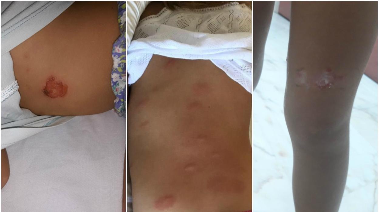 Mosquito tigre en Córdoba | «Llevamos unas semanas horribles con heridas espantosas»