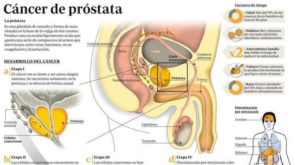 Todo lo que necesitas saber sobre el cáncer de próstata | Incidencia, tratamientos y avances en Córdoba