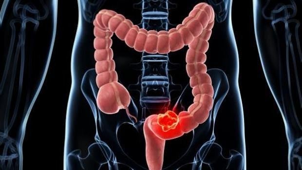 Cerca de 700 personas fueron diagnosticadas de cáncer colorrectal el año pasado en Córdoba
