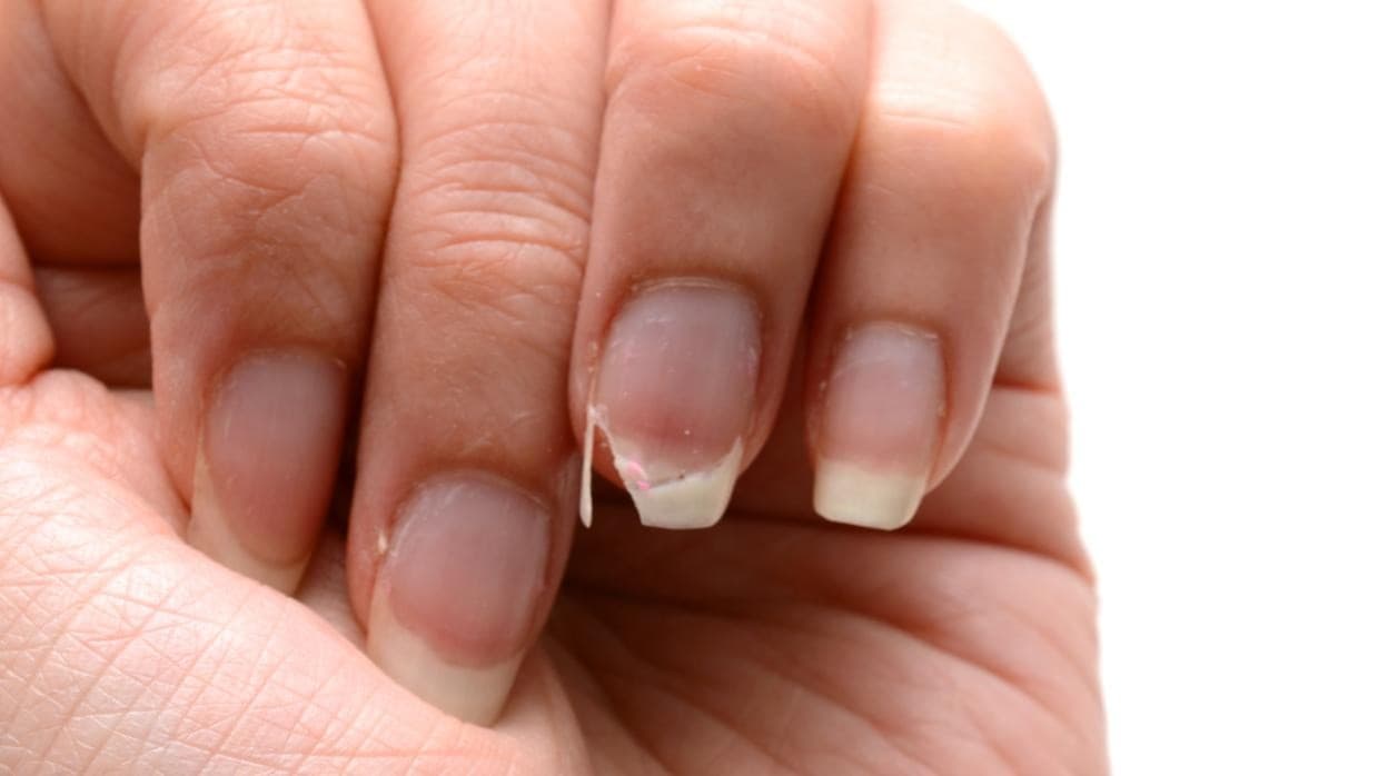 Deformidades distrofias y coloración de las uñas  Trastornos de la piel   Manual MSD versión para público general
